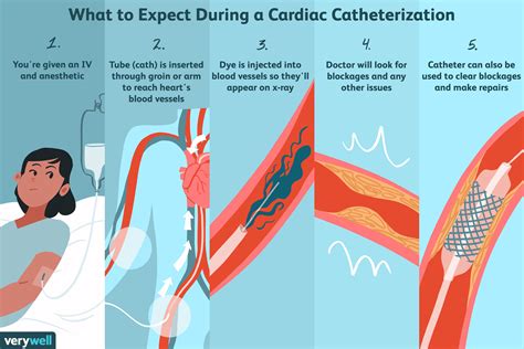 Cardiac Catheterization Procedure